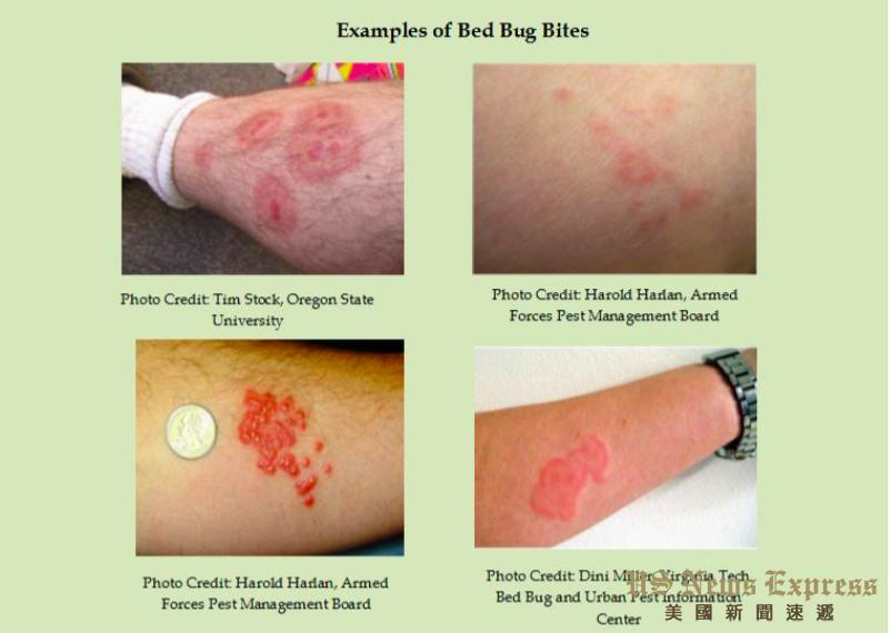 床虱来袭纽约、洛杉矶皆沦陷出游度假需谨慎