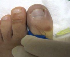 脚突然就出汗发臭,脚没烂不痒却散发出臭味