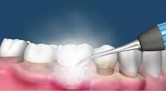 牙医科普洗牙,鹌鹑蛋洗牙后遗症