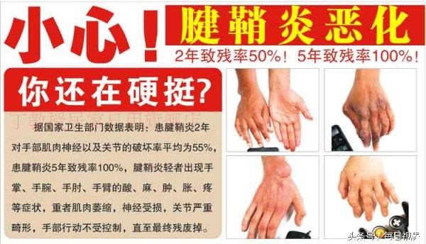 治疗腱鞘囊肿的特效方子真灵验,怎么自己在家捏爆腱鞘囊肿