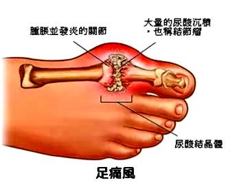 你知道哪些中药治痛风,请问中药治疗痛风怎么用