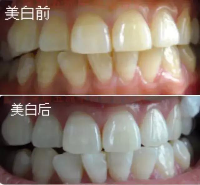 关于牙齿你需要知道的三件事,关于美白那些你不得不知道的事儿