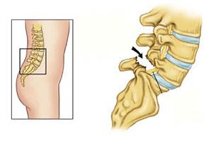 腰椎滑脱不做手术行吗,腰椎滑脱有必要做手术吗