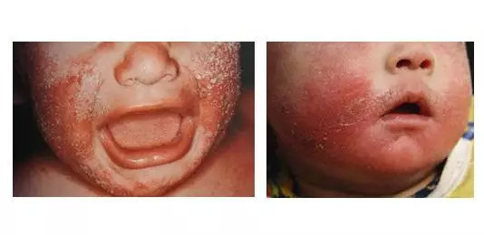 皮肤皮炎湿疹咋治,皮炎湿疹和皮肤过敏的区别