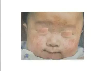 皮肤皮炎湿疹咋治,皮炎湿疹和皮肤过敏的区别