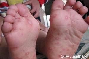 男童发烧38度一直降不下来怎么办,男童高烧39度吃药不退