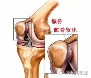 膝关节痛的危险信号,膝关节疼痛的原因及诊断思路