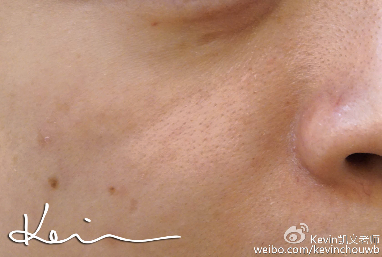 美妆去粉刺最有效的产品,痘痘粉刺黑头用什么化妆品