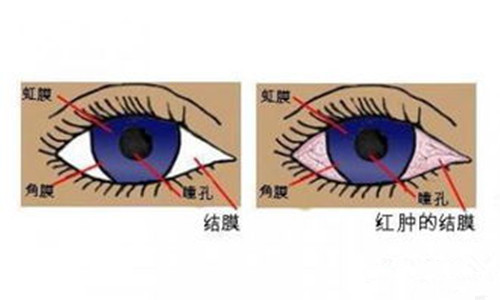 鼻炎引起的眼睛痒的小妙招,鼻炎引起的眼睛痒有什么小妙招