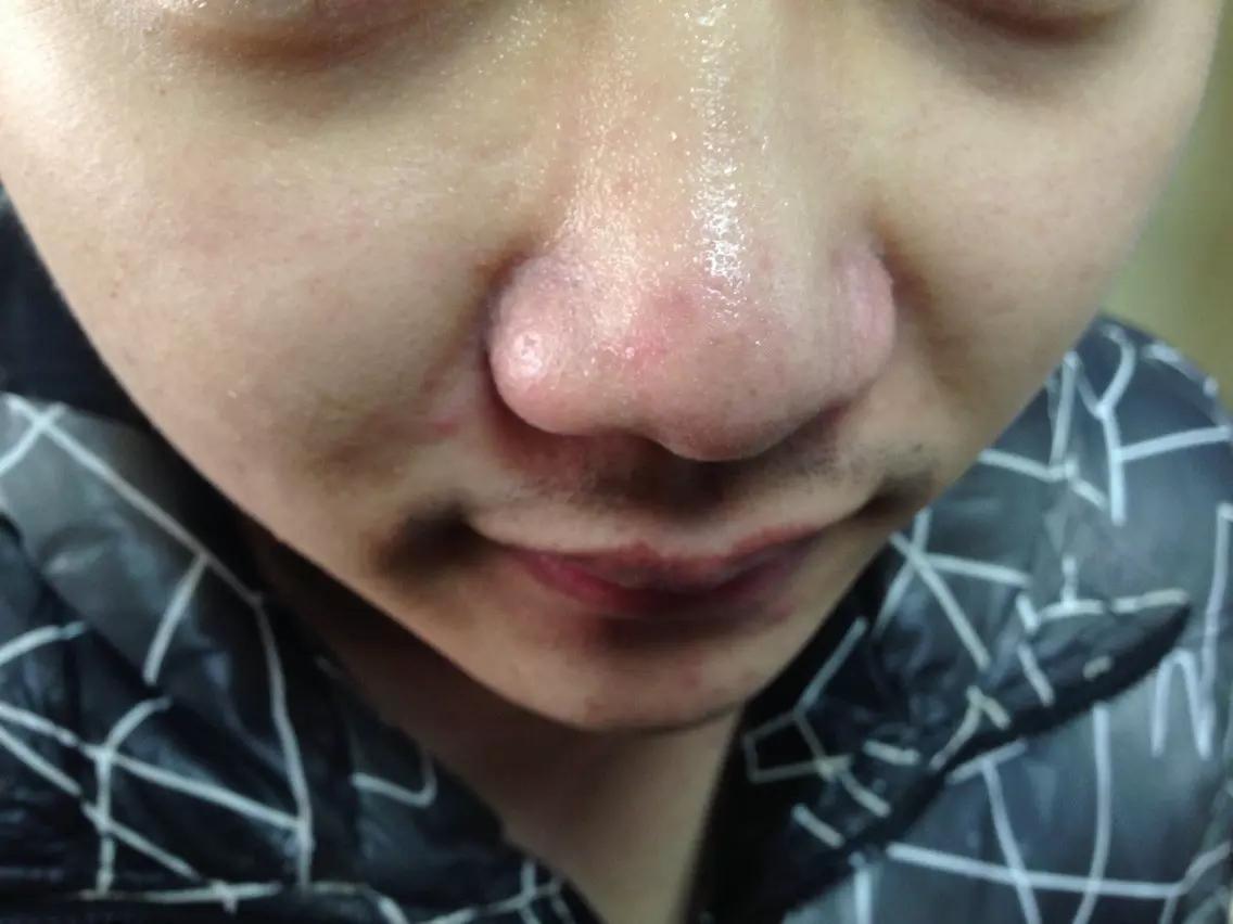 手把手教你有效去黑头的方法,手把手祛黑头