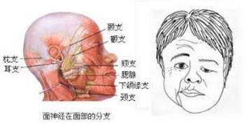 头发没干睡觉会引起面瘫吗,头发没干睡觉会面瘫