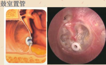 如何治疗分泌性中耳炎,分泌性中耳炎能自愈吗