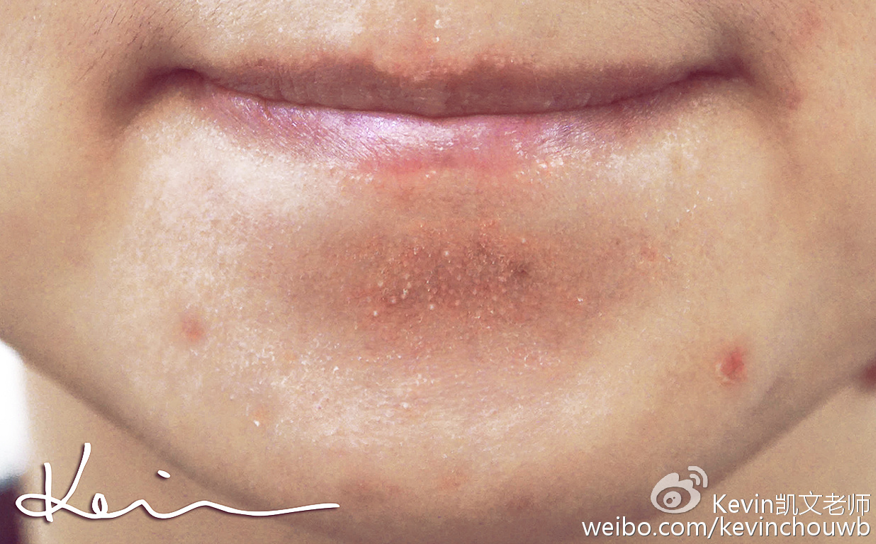 美妆去粉刺最有效的产品,痘痘粉刺黑头用什么化妆品