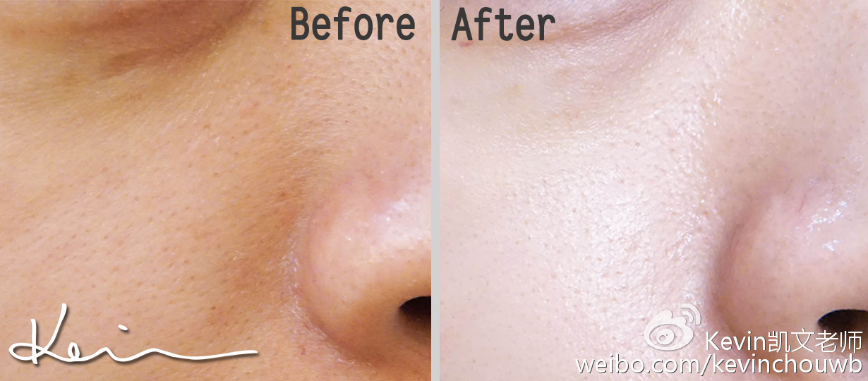 美妆去粉刺最有效的产品,痘痘粉刺黑头用什么化妆品