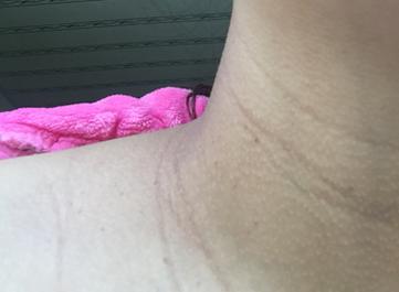 怀孕七个月腋窝和乳房变黑吗,怀孕脖子和腋窝黑是什么原因