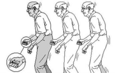 老人全身抖动的治疗方法,老年人颤抖需要治疗么