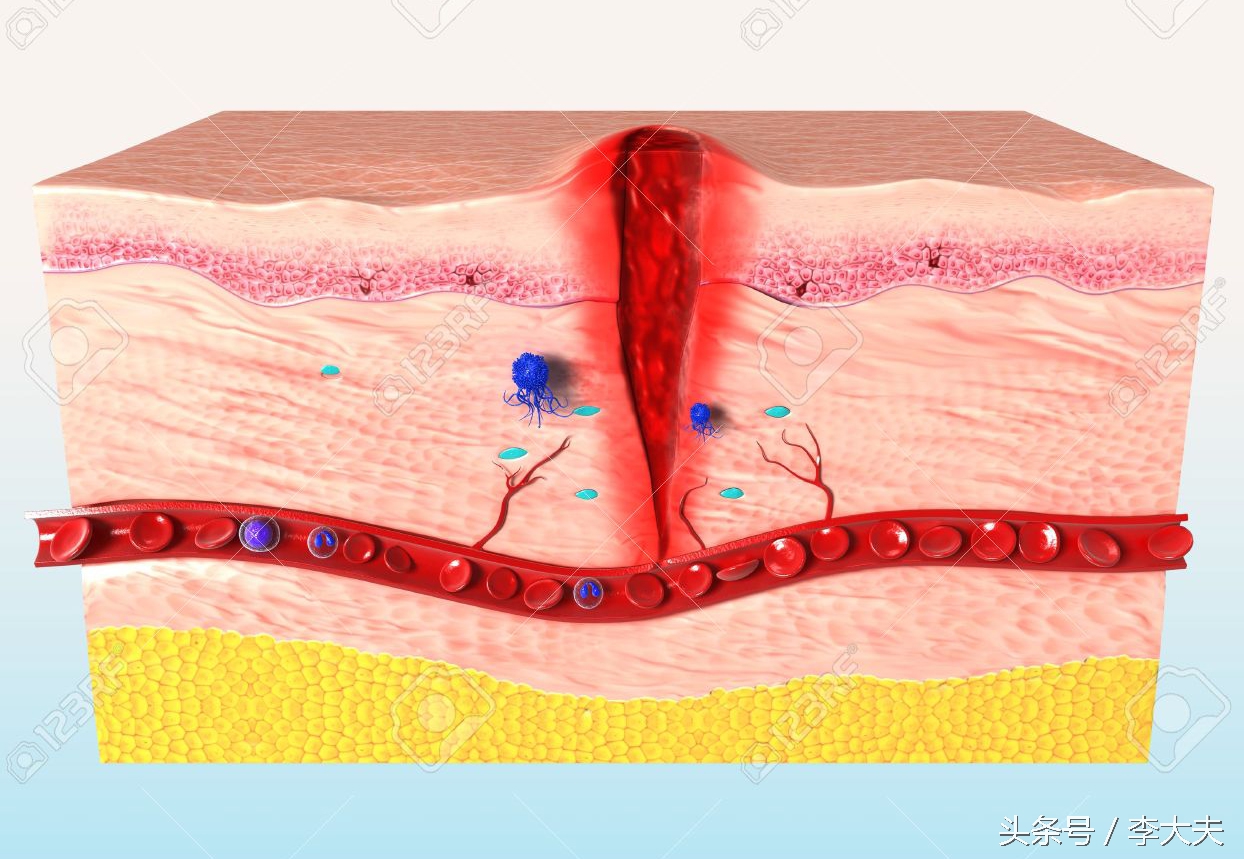 皮肤伤口增生,皮肤伤口愈合后反复长角质