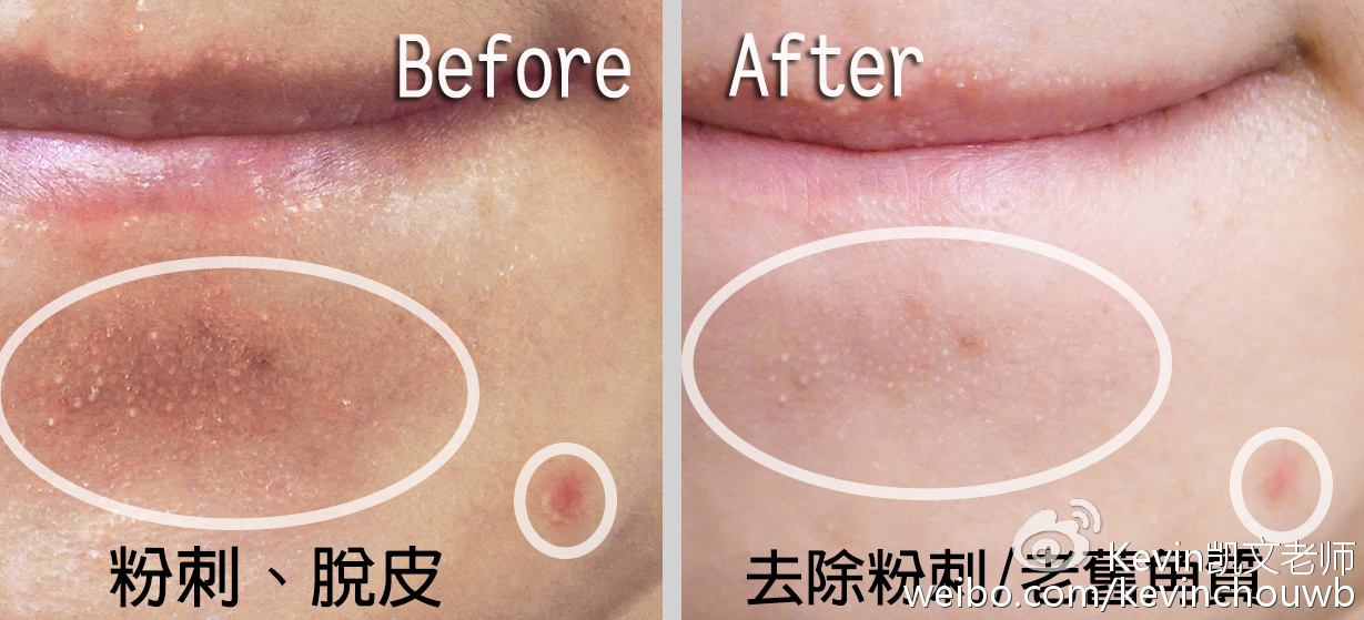 美妆去粉刺最有效的产品,痘痘粉刺黑头用什么化妆品