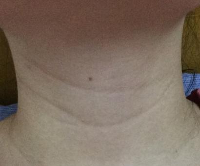 怀孕七个月腋窝和乳房变黑吗,怀孕脖子和腋窝黑是什么原因