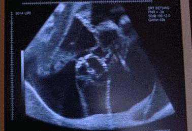 孕38周胎动几乎没有了,孕妈别把胎动不当回事