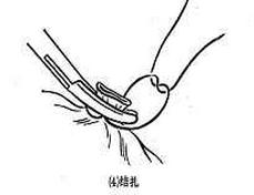 女性结扎恢复的手术过程,女性结扎的手术流程