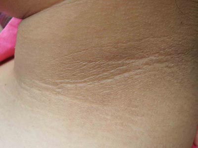 怀孕七个月腋窝和乳房变黑吗,怀孕脖子和腋窝黑是什么原因