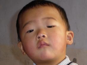 重度上睑下垂矫正方法,如何选择上睑下垂手术时机