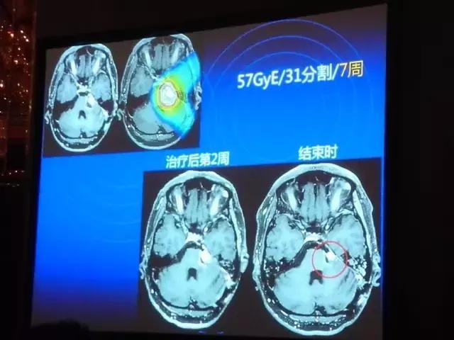 癌症复发转移还可以做质子治疗吗,质子治疗后复发可以用质子治疗吗