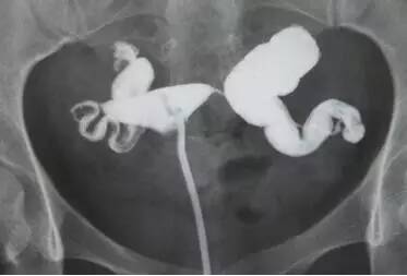 子宫输卵管造影结果判读的误区