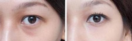 开眼角手术的利与弊,开眼角手术成功的后遗症是什么