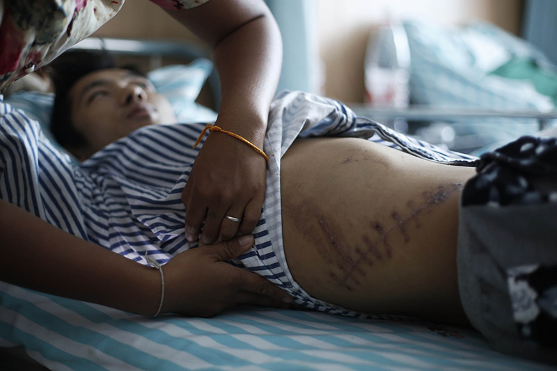 男子切除右肾后体检惊现两个肾,男子手术后左肾离奇消失