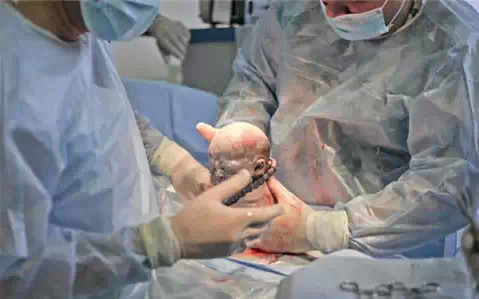 剖腹产必须知道的9个方面,剖腹产怎么才能轻松点