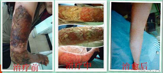 张祥英亲历:右臂三度烧伤28天治愈不植皮