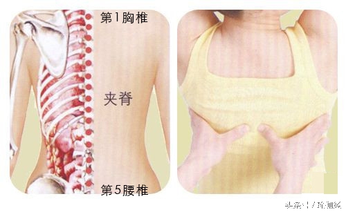 脊柱侧弯驼背怎么矫正,脊柱侧弯驼背怎么恢复