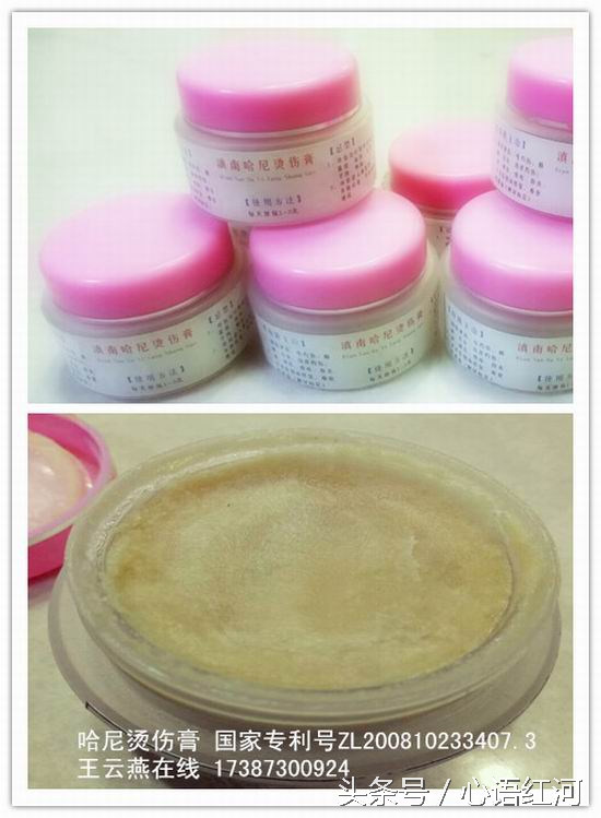 张祥英亲历:右臂三度烧伤28天治愈不植皮