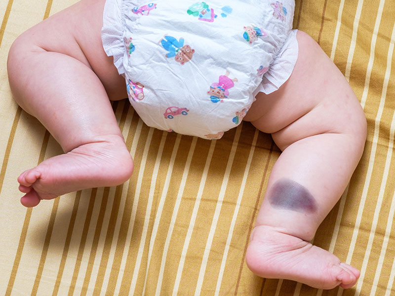 小孩青色胎记会自行消退吗,胎记哪种可以慢慢淡去