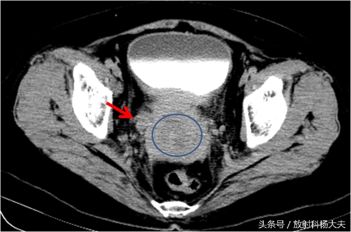 老人检查出肾积水,女老人肾积水怎么治最好