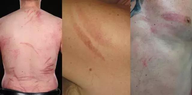 巴西男子身上莫名出现多处“鞭”痕,只因做了这件事...
