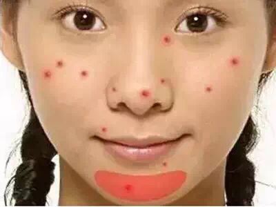 下巴周围上长脓包型痘痘怎么消除,下巴周围反复长痘痘怎么治疗最好