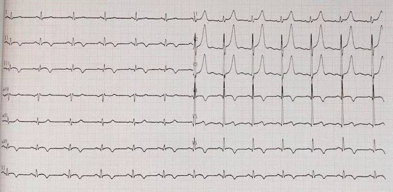 心力衰竭治疗要点的思维导图,心力衰竭疑难病例讨论记录模板