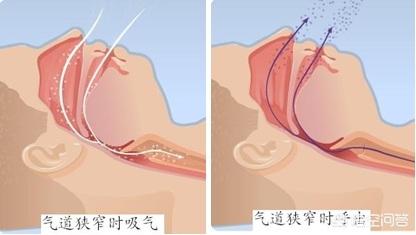 睡觉打呼噜最好的治疗方法,为什么只有睡觉时才打呼噜