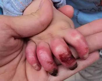 如果你不小心被烫伤了怎么办,烫伤之后你该怎么做