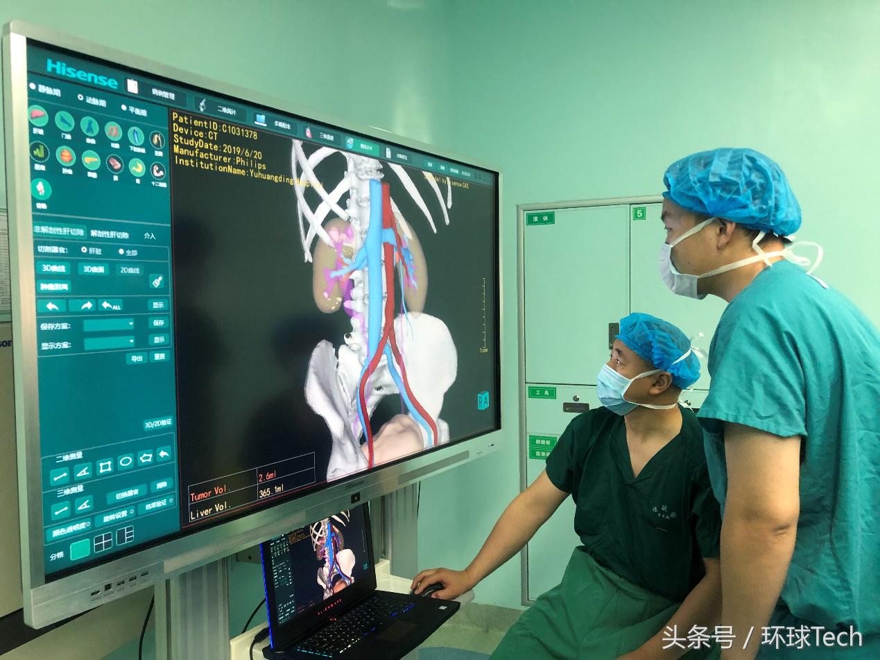 山东省立医院肾结石微创,肾结石3.2厘米微创手术