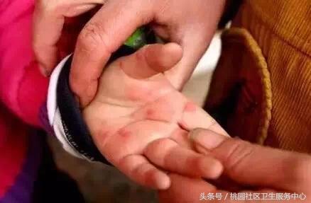 手足口病高发教你如何预防与治疗,一图读懂手足口病的科普与防护
