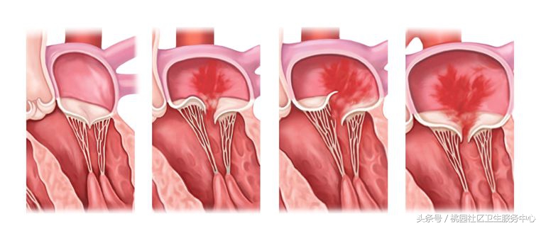 心脏支架说明书,这份通俗易懂的心脏说明书请收好