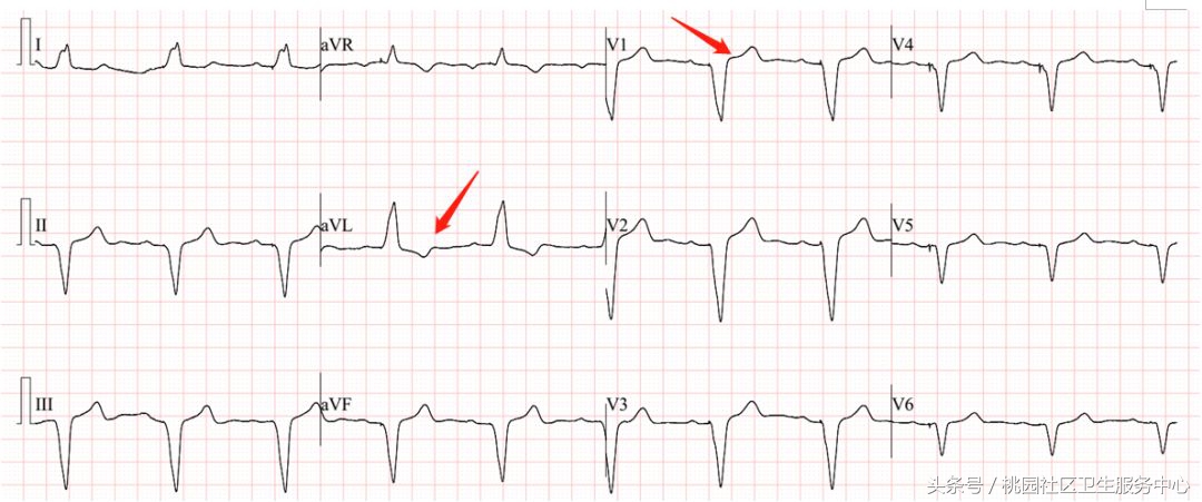 继发性stt异常是什么意思,心电图继发性st-t改变是什么意思