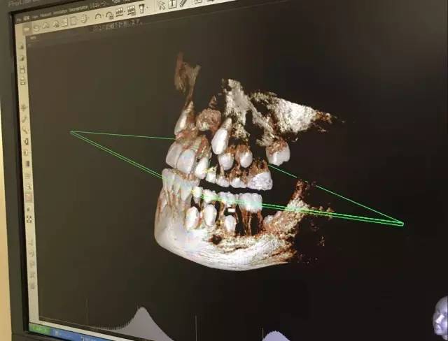牙医爸爸帮小孩检查牙齿,儿童牙齿矫正父母必看