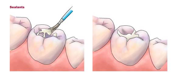牙医爸爸帮小孩检查牙齿,儿童牙齿矫正父母必看