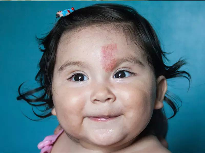 小孩青色胎记会自行消退吗,胎记哪种可以慢慢淡去