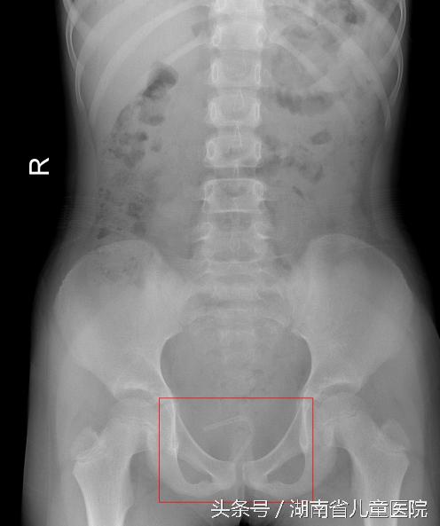 女童妇科病是什么原因,女医生不小心发现女童有妇科病